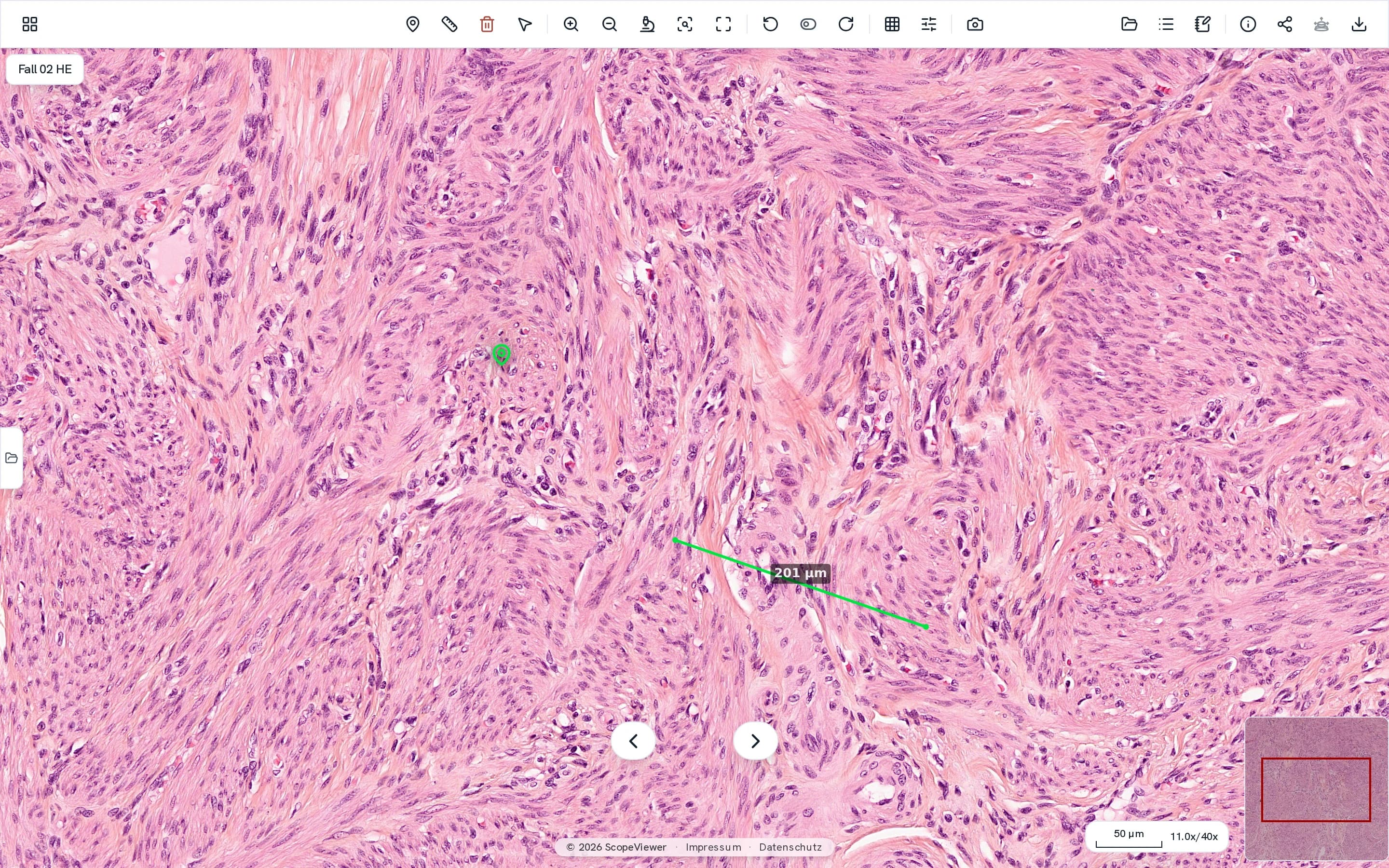H&E section at 11x magnification, with one marker and a measurement of 201 µm